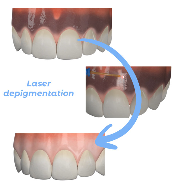 GINGIVAL DEPIGMENTATION